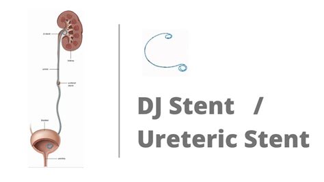 DJ Stent for Kidney Stones - Dr. Sumit Sharma Urologist Gurgaon