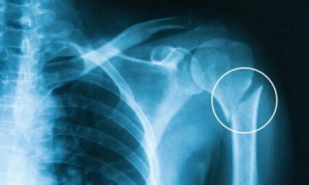 The Role of Physiotherapy in Shoulder Fracture Rehabilitation - Star Two