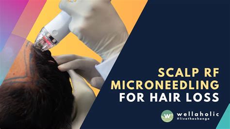 Scalp Rf Microneedling By Wellaholic Youtube