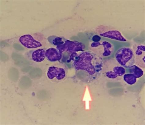 Bone Marrow Aspirate Showing Hemophagocytosis By Histiocytes Arrow