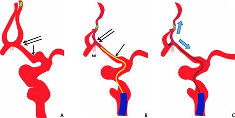 A Proposed Mechanism Of Anterior Communicating Artery Acom