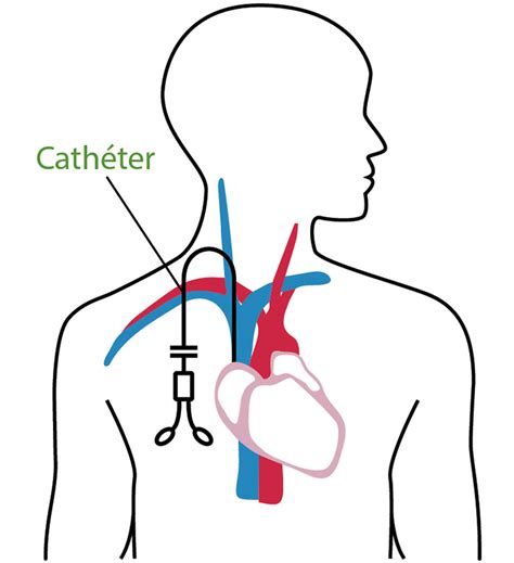 Types Daccès Corporel De La Dialyse Orn