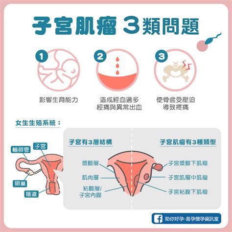 子宮後傾會引起經痛、腰痠？是否會降低懷孕機率？