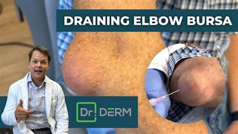 Draining Giant Elbow Bursa Dr Derm YouTube