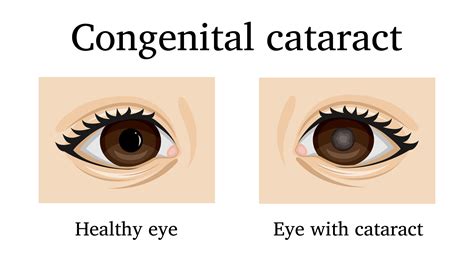 Understanding Congenital Cataracts World Eye Care Foundation