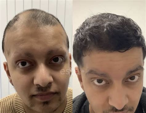 Extreme Recovery From Alopecia Hair Loss Before After Photos Este