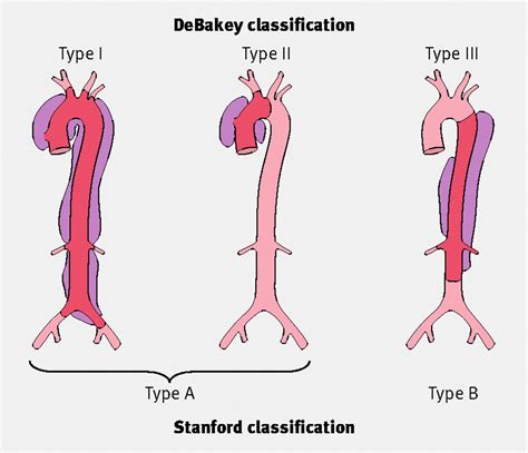 Acute Aortic Dissection The Bmj