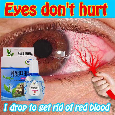 Eye Drops Itchy Eyes Relieves Red Eyes Discomfort Glaucoma Eye Drops ...