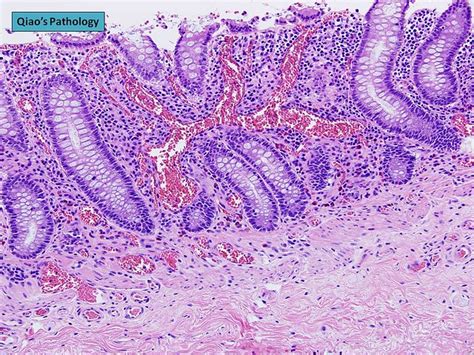 Qiao S Pathology Angiodysplasia Of The Colon A Photo On Flickriver