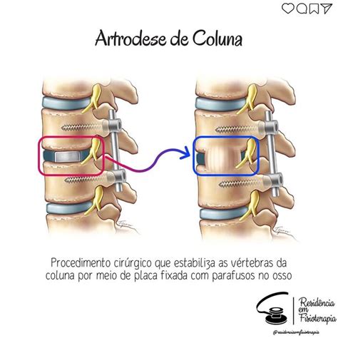 Resid Ncia Em Fisioterapia On Instagram Voc S Sabem O Que Artrodese