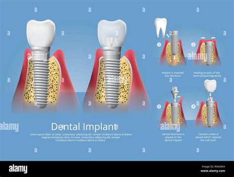 Human Teeth And Dental Implant Vector Illustration Stock Vector Image