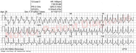 Hyperkalemia Ecg Guru Instructor Resources