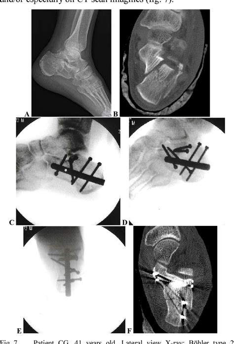 Figure 7 From C NAIL A New Implant For Minimally Invasive Treatment