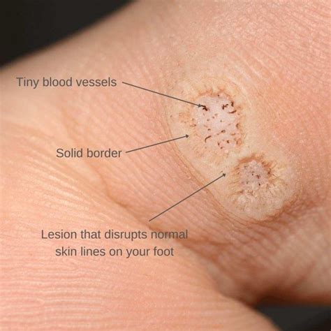 Black Dots Warts On Feet