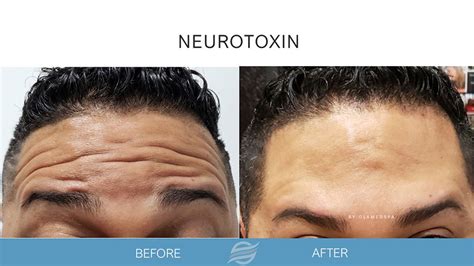 Botox and Neurotoxins - Olam Med Spa