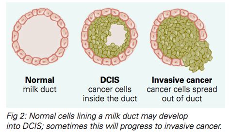 Invasive Ductal Carcinoma (IDC) National Breast Cancer, 51% OFF