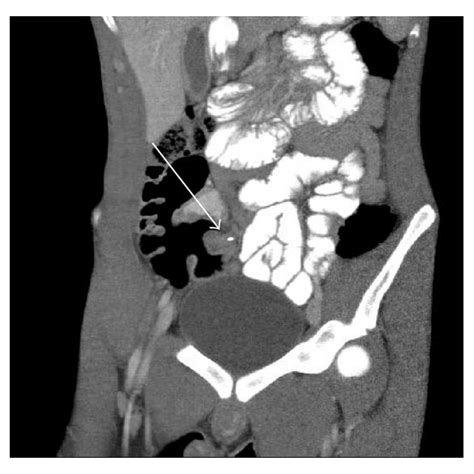 Retroperitoneal Air Straight Arrow Adjacent To Inflamed Retrocecal