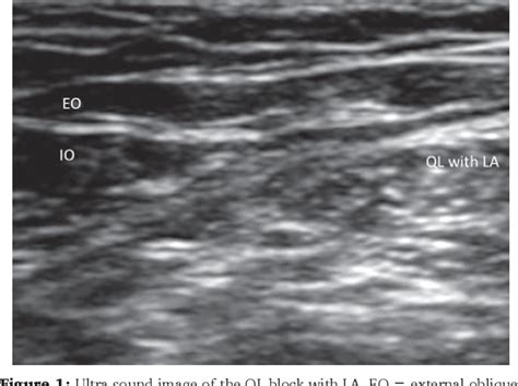 Figure 1 From Ultrasound Guided Quadratus Lumborum Block Or Posterior Transversus Abdominis