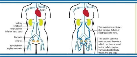 Pelvic Venous Disorders - Crestview Hills, KY: Vascular ...