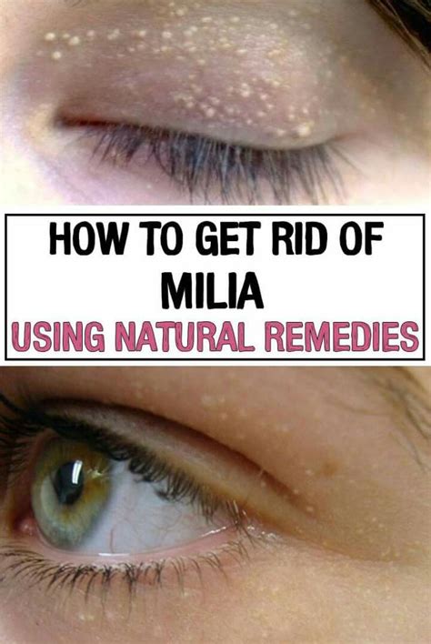 How To Remove Milia In Eyelid Howotremvo