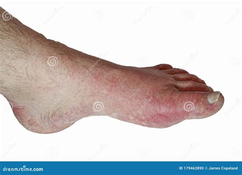 Foot of Gout Swollen Isolated on White Stock Photo - Image of ...