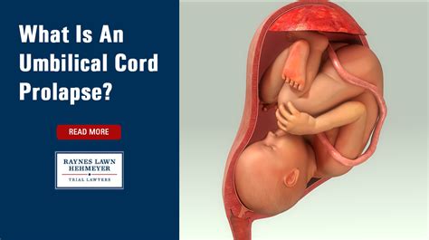 What Is An Umbilical Cord Prolapse Raynes Lawn