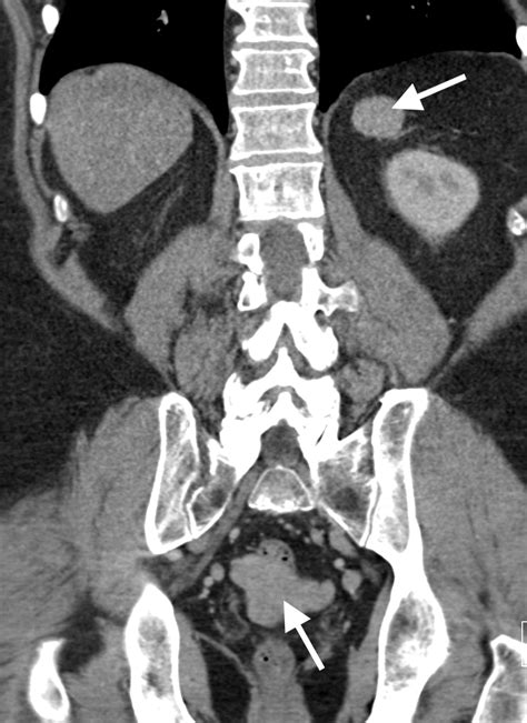 Splenosis Mimicking Prostate Cancer Recurrence Eurorad