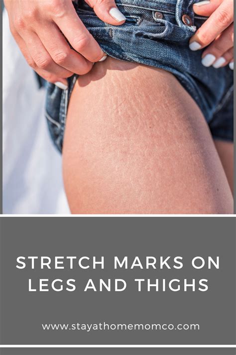 Strech Marks On Thighs Strech Marks Removal Stretch Marks On Legs Stretch Mark Cream How To