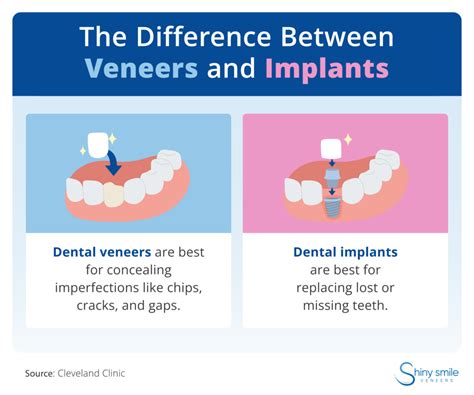 Veneers vs. Dental Implants: Which Is Right for You? | Shiny Smile Veneers