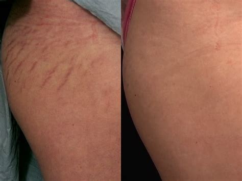 The Best Treatments For Stretch Marks According To Derms