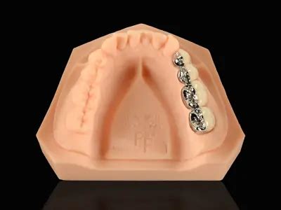 Porcelain Fused To Metal Pfm Metal Golden Smile Dental Lab