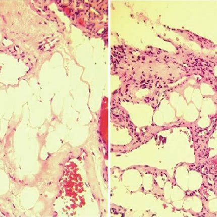 A And B Histological Examination Of The Lesion Showed Both Mature