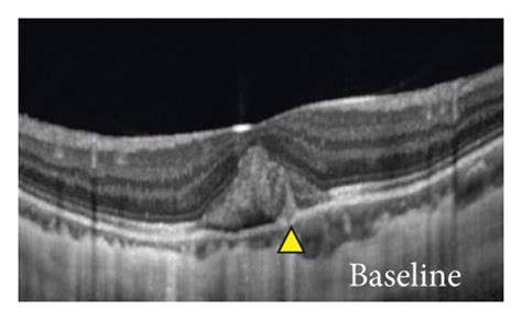 Multimodal Imaging Characteristics Of A 29 Year Old Girl With Acute