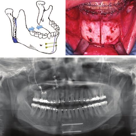 A B Condylar Rotation During Mandibular Setback Caused By Lateral Download Scientific Diagram