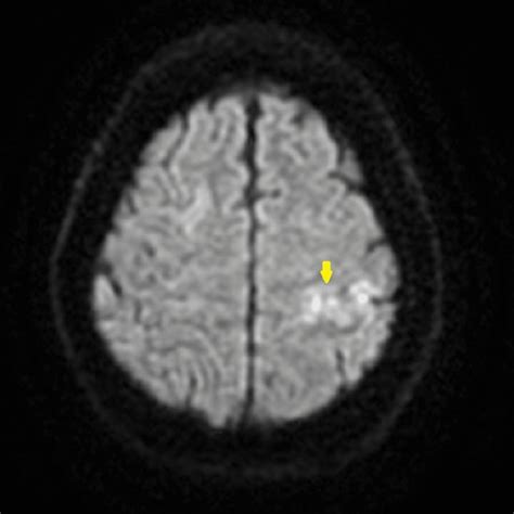 Axial view of MRI DWI sequence showing diffusion restriction signifying ...