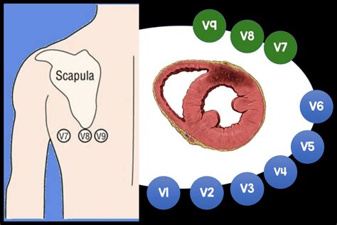 Placement of Posterior Leads - REBEL EM - Emergency Medicine Blog