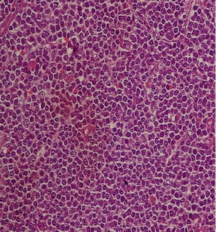 Histopathology slide of small lymphocytic lymphoma showing effaced... | Download Scientific Diagram