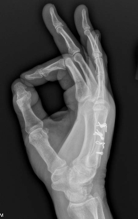 Dr. Sammy - Metacarpal Fracture