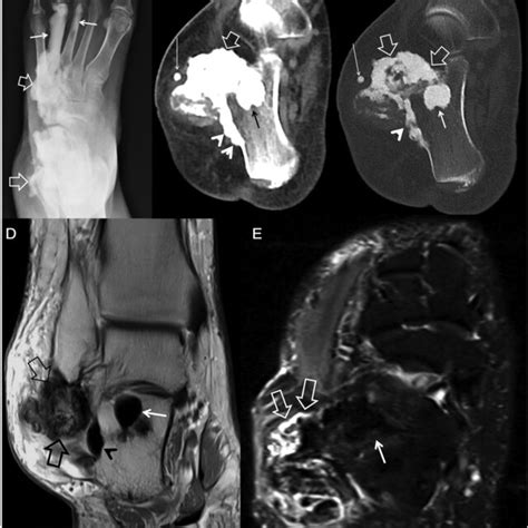 “shin Splints” In Melorheostosis A 46‐year‐old Male Melo‐2 Patient Download Scientific