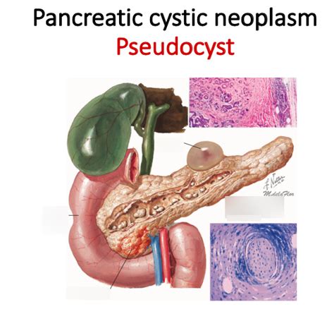 Pseudocyst Diagram | Quizlet