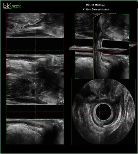 Przetoka Odbytu Leczenie I Diagnostyka Melita Medical