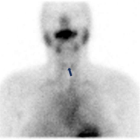 Thyroid Scan Showing Thyroiditis The Arrow Shows Decreased Uptake Of