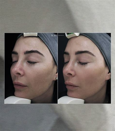 Reviewed Cosmelan Md Peel For Melasma Who What Wear