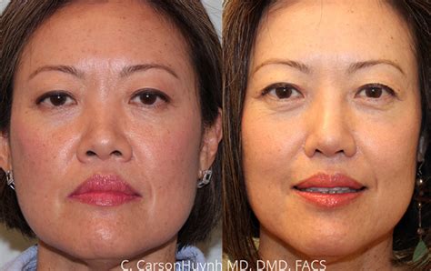 Asian Rhinoplasty Case 3185 Radiance Surgery Aesthetic Medicine