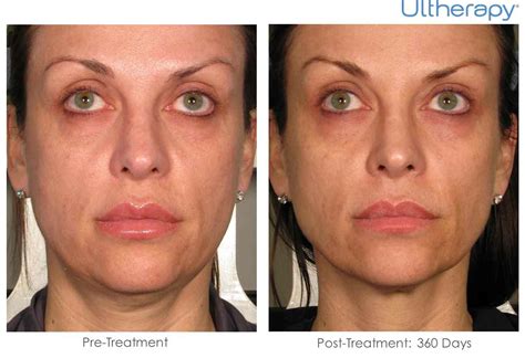 Ulthera Ultherapy Comes To Ethos Spa Skin And Laser Center In New Jersey Nj Ethos Spa