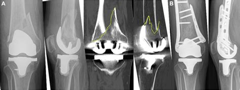 New Classification For Periprosthetic Distal Femoral Fractures Based On Locked Plate Fixation