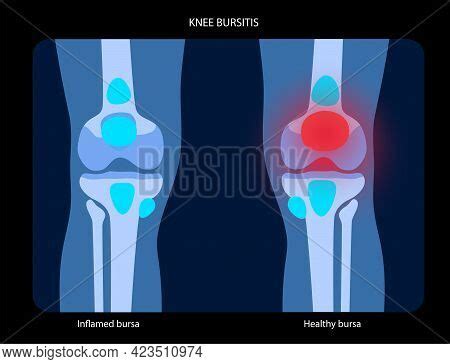 Knee Bursitis Vector & Photo (Free Trial) | Bigstock