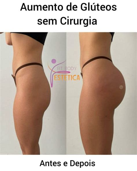 Aumento De Gl Teos Sem Cirurgia Cl Nica Fit Body Est Tica