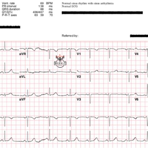 Normal ECG – ECG Weekly