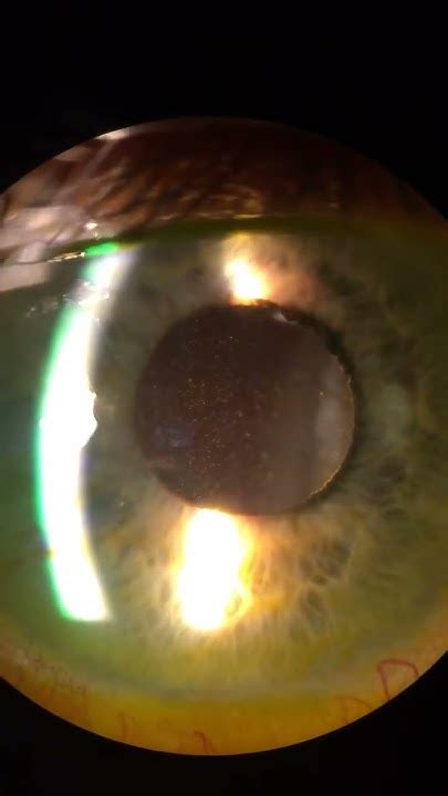 Anterior Chamber Cells Youtube